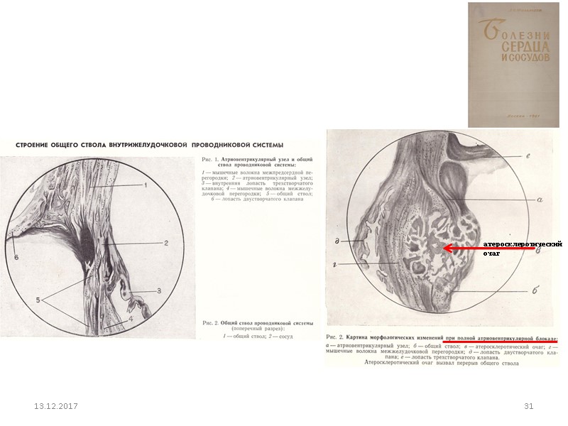 13.12.2017 31 атеросклеротический  очаг